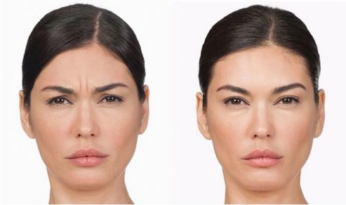 Brow lift